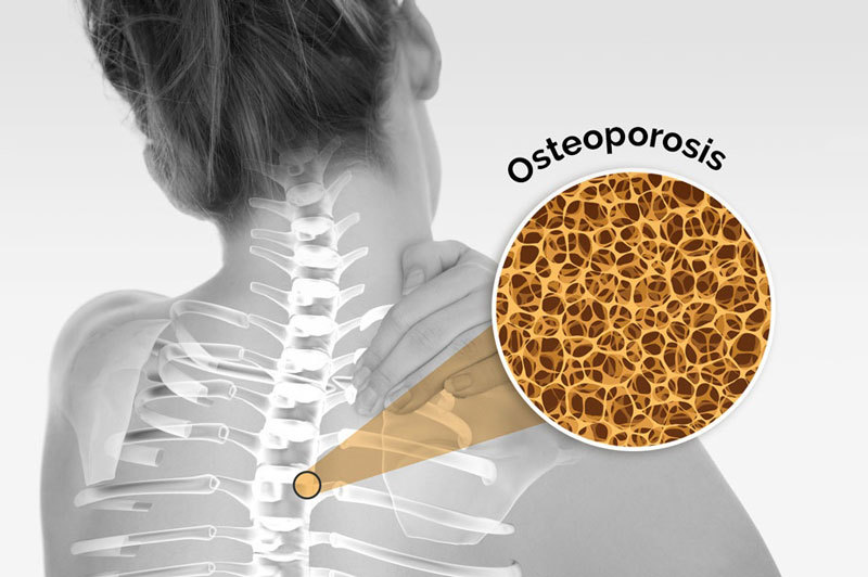 Метаболизм костей и остеопороз
